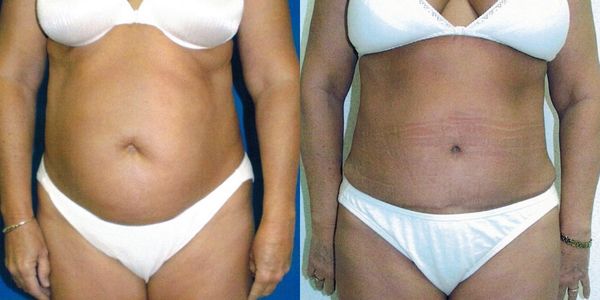 Tummy Tuck Before and After Patient 32 2