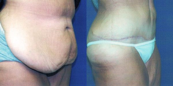 Tummy Tuck Before and After Patient 74 2