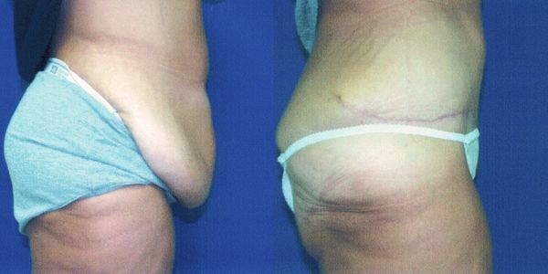 Tummy Tuck Before and After Patient 74