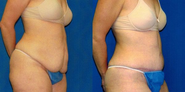 Tummy Tuck Before and After Patient 75 2