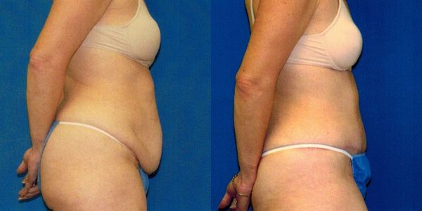 Tummy Tuck Before and After Patient 75