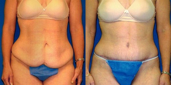 Tummy Tuck Before and After Patient 75 3