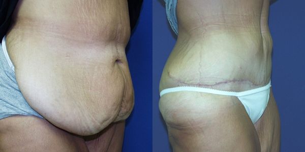 Tummy Tuck Before and After Patient 76 2