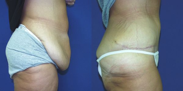 Tummy Tuck Before and After Patient 76