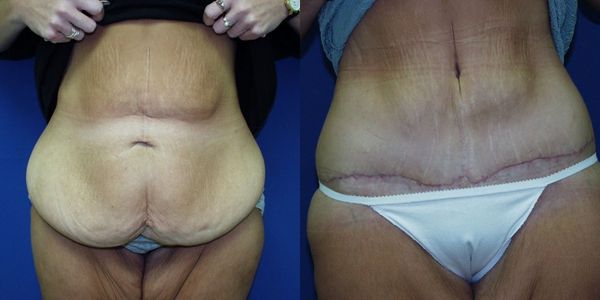 Tummy Tuck Before and After Patient 76 3