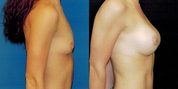 Breast Augmentation Before and After Patient 60 - 5