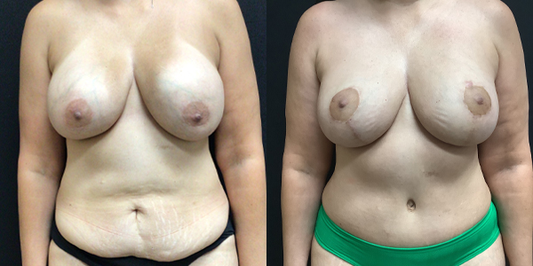 Breast Implant Exchange, Abdominoplasty - Before and After 88