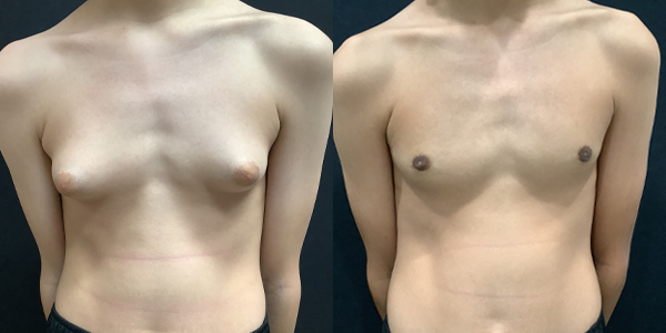 Male Breast Reduction Before and After 93 front
