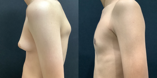 Male Breast Reduction Before and After 93