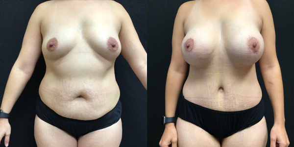Mommy Makeover, Breast Augmentation and Lift - Before and After Patient 169 front