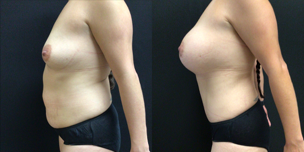 Mommy Makeover, Breast Augmentation and Lift - Before and After Patient 169