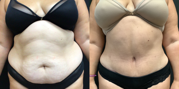 Ultrasonic Liposuction Before and After 184